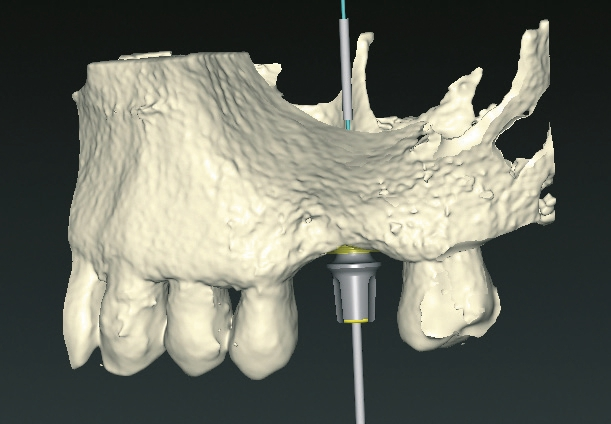 Abb. 3: Virtuelle 3D-Planung für den zweiten Patientenfall.