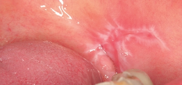 Abb. 4: Manifestation eines Lichen ruber mucosae mit typischer Wickham-Streifung, Planum buccale links.