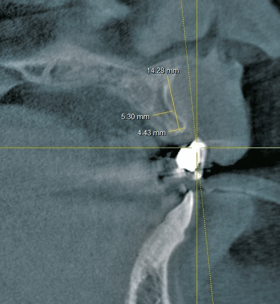 Abb. 2b: Die Planung für die bestmögliche Implantatpositionierung.