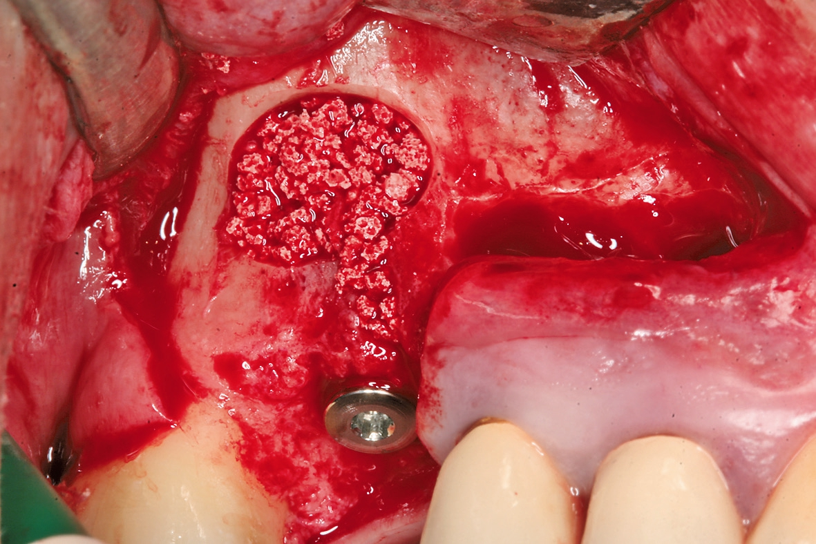 Abb. 4: Vollständige Augmentation des Kieferhöhlenbodens nach erfolgter Implantatinsertion.