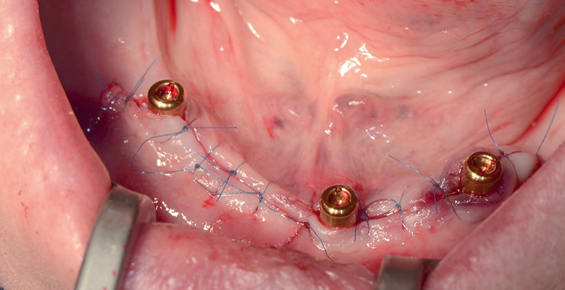 Abb. 1: Versorgung mit 3 Implantaten und Locatoren im zahnlosen Unterkiefer bei transgingivaler Einheilung.