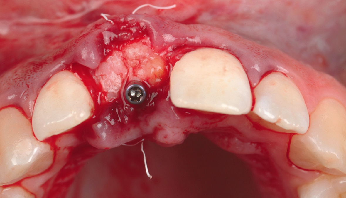 Ein Bindegewebetransplantat wurde dem Tuber maxillae entnommen und an der Position um den Slim Gingivaformer angenäht.
