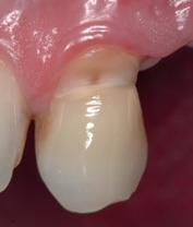 Abb. 4: Eindeutige Abrasion an einem oberen linken Eckzahn. Die keilförmige Ausprägung der zervikalen Zahnabnutzung weist auf zu viel horizontal „sägende“ Zahnbürstenbewegungen hin.