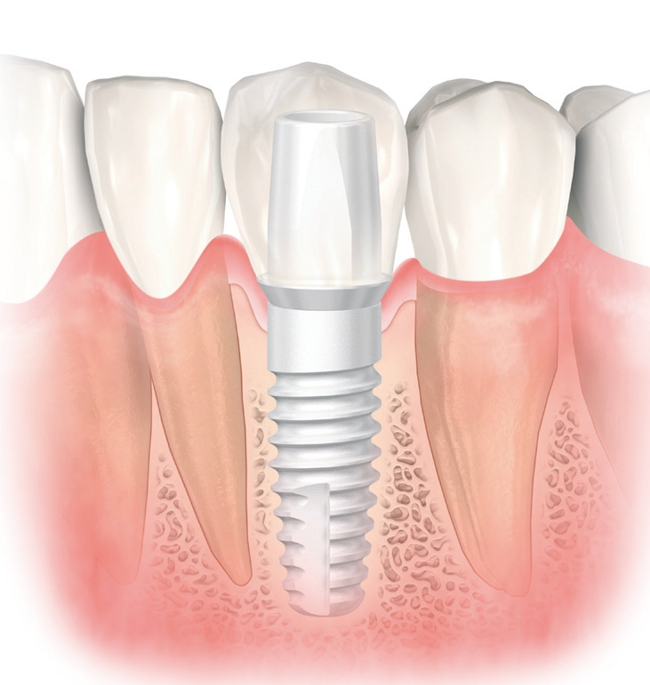 Das weisse Material ist besonders vorteilhaft für Patienten mit dünnem Gingiva-Biotyp.