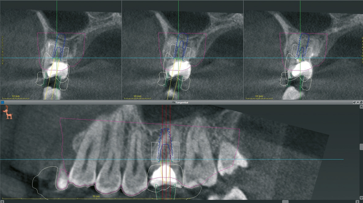 Abb. 4: Virtuelle Planung des Implantats samt Knochenring in regio 26.