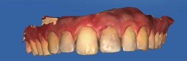 Abb. 4a: Zahn 21 wurde in CEREC radiert, um die postoperative Ausgangssituation zu simulieren.