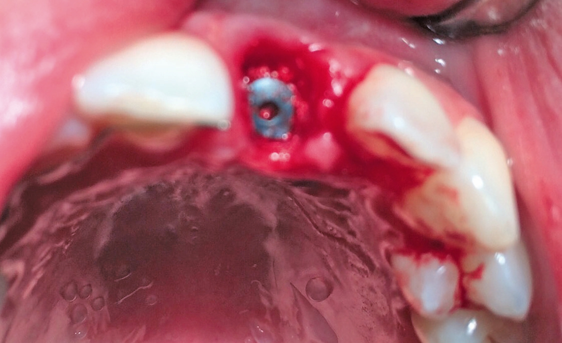 Abb. 12: Nach der Entfernung des Zahnes 21 wurde sofort implantiert (Astra Tech Implant System EV, Dentsply Sirona) und außerdem in die Alveole zusätzlich Knochenersatzmaterial eingefüllt.