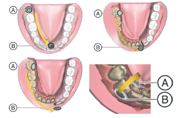 Abb. 4a–d: Scanprotokoll eines Quadranten in Cerec Ortho.