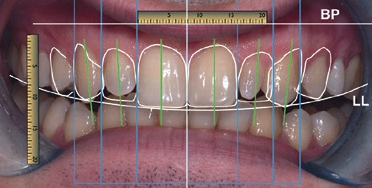 Abb. 4: Digital Smile Design; BP: Bipupillarlinie; LL: Lachlinie; Goldener Schnitt und das digitale Lineal zur Kommunikation mit dem Zahntechniker.