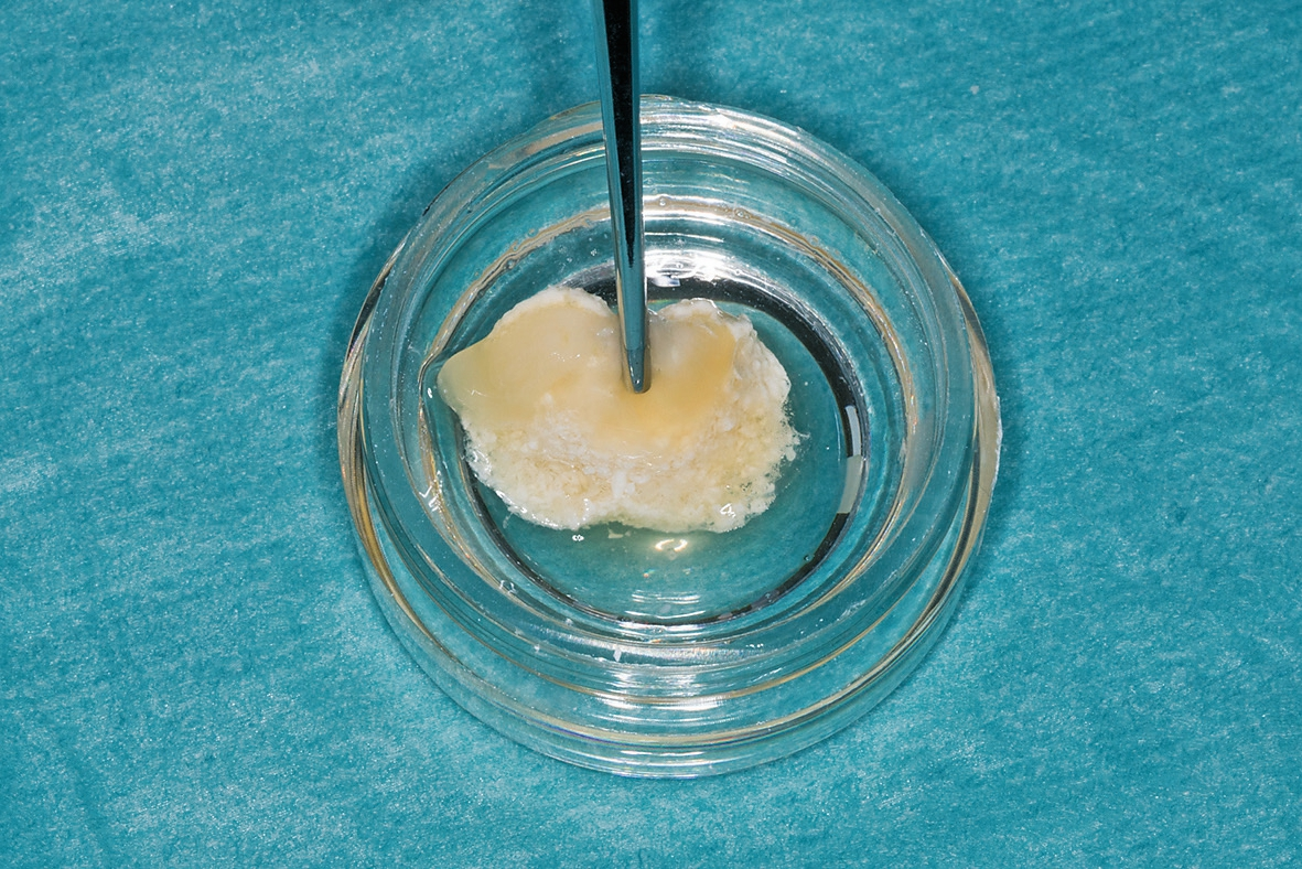 Abb. 4: KEM mit i-PRF gemischt, sogenannter „sticky bone“.