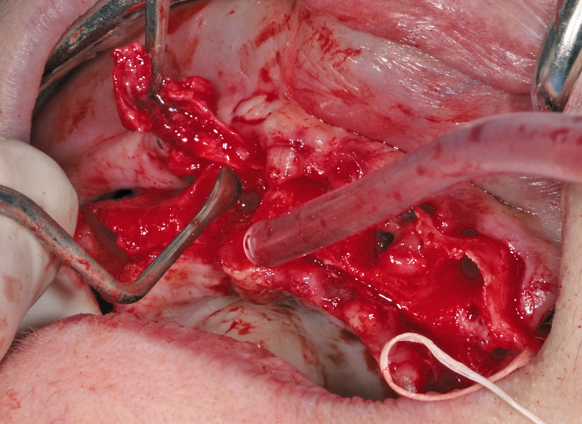 Abb. 4: Intraoperative Säuberung der Situation nach Hebung eines vollen Zahnfleischlappens und Darstellung des Knochens und der enthaltenen Zysten. Hier Entfernung der Zyste in regio 13 nach Entfernung aller Zähne im Oberkiefer.