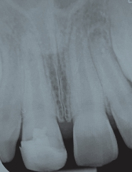Abb. 4: Zustand nach 9 Monaten, deutlich erkennbares Längenwachstum der Wurzel und Zunahme der Dentinwände.