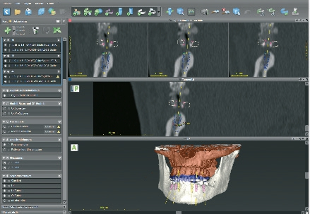 Abb. 4: Screenshot der virtuellen Implantatplanung im Unterkiefer (Labor Cera-Technik, München).