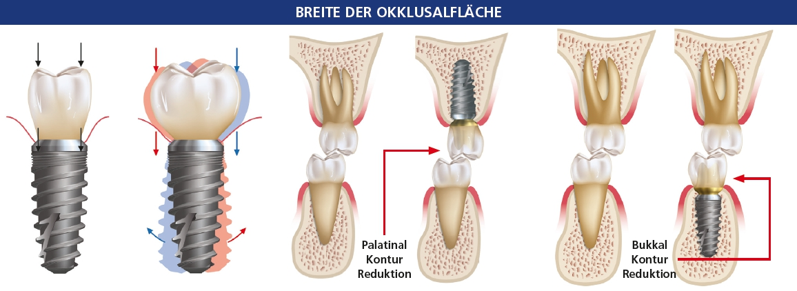 Abb. 2c: Kräftebezogene Unterschiede zwischen idealer und zu großer okklusaler Fläche. Beachten Sie, dass der Kronenrand mit dem Durchmesser des Implantatkörpers übereinstimmen sollte. Auch die Höckerhöhe sollte reduziert werden. Wenn die Okklusalfläche zu groß ist, entstehen Scherkräfte. Diese wirken sich nachteilig auf den das Implantat tragenden Knochen aus. Abb. 2d: Die Okklusionsfläche sollte durch eine Senkung der palatalen Grenze der Implantatkrone im Oberkiefer verringert werden. Abb. 2e: Für eine Implantatprothese des Unterkiefers sollte der bukkale Umriss der Implantatkrone verringert werden.