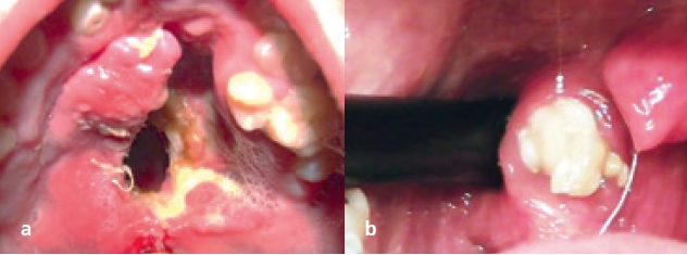 Abb. 2a: Gaumenspalte. Abb. 2b: Tonsillolith.