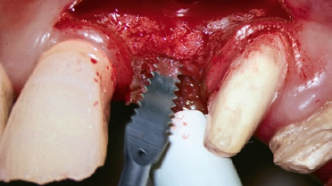 Sonosurgery Schallsäge SFS101 axial – für minimalinvasive Knochenschnitte bei vollkommener Kontrolle.