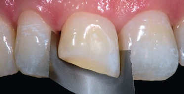 Abb. 4: Zur besseren Konditionierung der Oberfläche und Gestaltung abgerundeter Kanten soll der Zahn mittels Pulverstrahl Al(2)O(3) (Aqua Care, American Dental Systems) abgestrahlt werden. Dazu wird zum Schutz der Nachbarzähne ein vorgebogener Metallstreifen (Matirizenband) um den Zahn positioniert.
