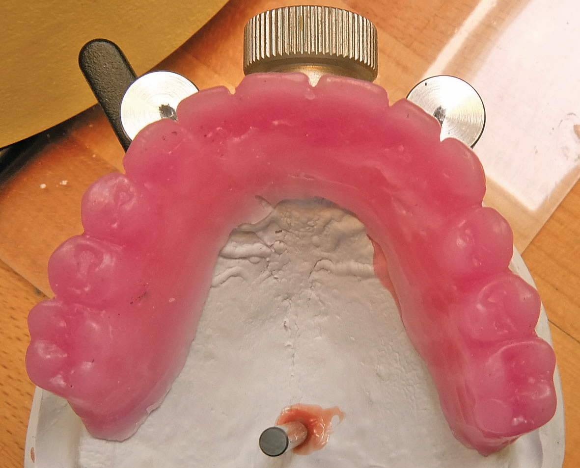 Abb. 63: Von der Klarsichtschablone wurde ein Duplikat angefertigt, das unser Wax-up darstellte.
