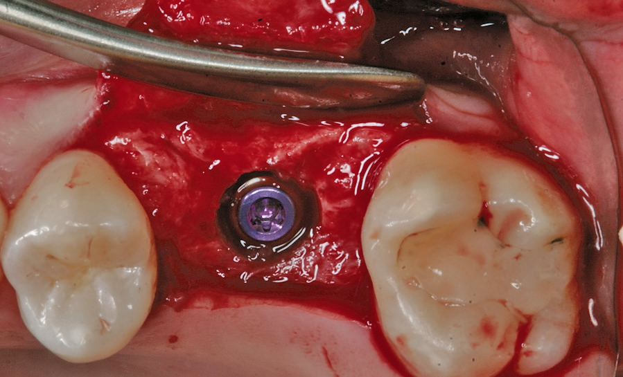Abb. 4: Zentale, subcrestale Insertion des Implantates (copaSKY, bredent medical, Senden) .