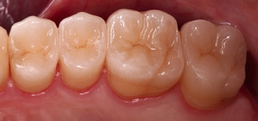 Abb. 2b: Monolithische Okklusionsonlays aus Abb. 2a nach der Eingliederung mit Adhese Universal und Variolink Esthetic LC der Farbe „warm“.