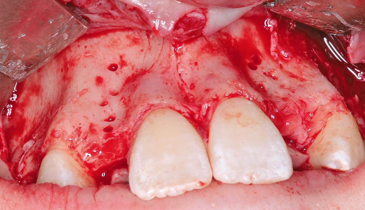 Abb. 5: Bleeding-Points zur Förderung der Durchblutung des allogenen Transplantates.