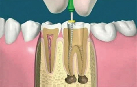 Abb. 5: Analog der CNIP-Navigation kann man mit einer Hand- oder niedrig-tourigen Kanalaufbereitung bei einer Endodontie die Seitenwände nicht perforieren.