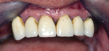 Abb. 4: Zustand nach systematischer Parodontitistherapie: vollständige Rückbildung der Gingivahyperplasie.