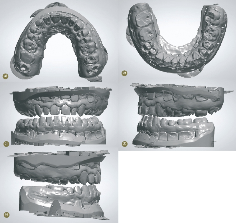 Abb. 4: 3D-Scan der Gipsmodelle für die Herstellung der Langzeitprovisorien. a) Oberkieferaufsicht. b) Unterkieferaufsicht. c) Virtuelle Zuordnung der Kiefer zueinander. d) Rechte Seitenansicht der virtuellen Zuordnung. e) Linke Seitenansicht der virtuellen Zuordnung.