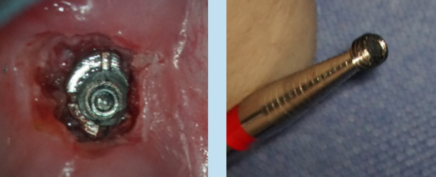 Abb. 6 u. 7: Situation nach Entfernung des Konus aus dem Implantat und Entnahme der Schraube.