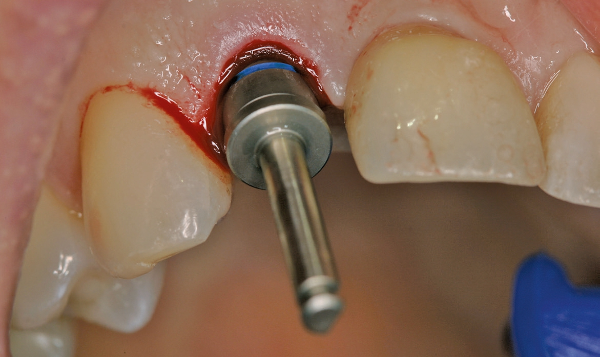 Abb. 4: Leicht palatinale Implantatbohrung nach Trennung der Wurzel in bukkalen und oralen Anteil.