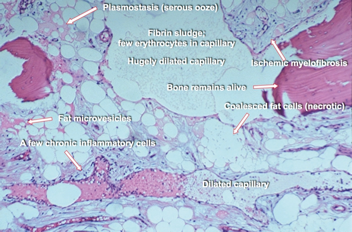 Abb. 5: Histologisches Bild einer KO mit Plasmostasis, Ölzysten, fettigen Mikrovesikeln und chronischem Entzündungsinfiltrat.