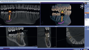 Abb. 4: Behandlungsplanung in Galileos Implant.
