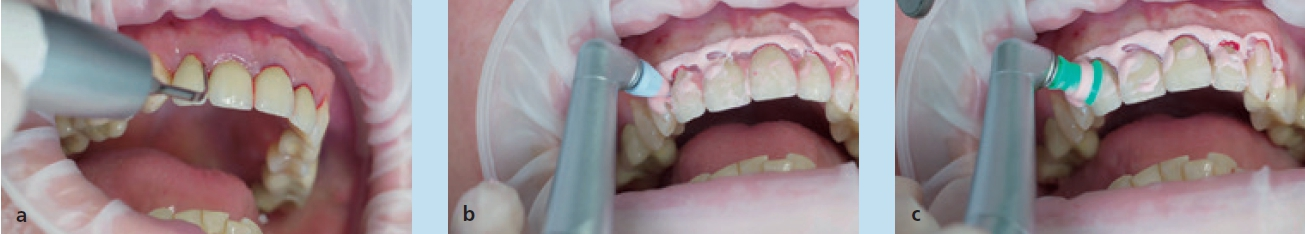 Abb. 4 a) Ultraschallscaler (Tigon mit Spitze P1, W&H, Bürmoos, Österreich) bei intraoraler Anwendung an Zahn 12 im Rahmen der unterstützenden Parodontitistherapie. Zur besseren Übersicht sowie für ein effizienteres Behandeln wurde OptraGate® angelegt (Ivoclar Vivadent AG, Schaan, Fürstentum Liechtenstein). b) Abschließende Politur mit Gummikelch. c) Interdental-Gummikeil und Polierpaste (beide W&H, Bürmoos, Österreich).