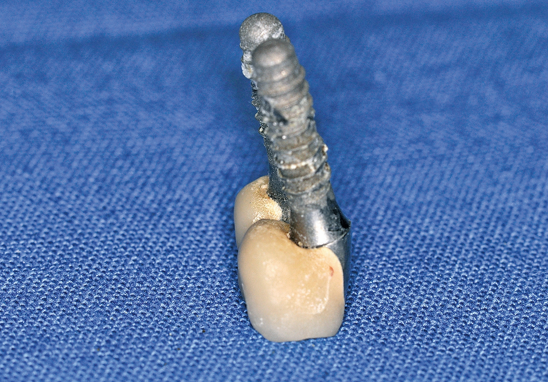 Abb. 5: Schwer zu reinigende vestibuläre Kronengestaltung: Verlängerte faciale Kronenfl äche bei ungünstiger Achsstellung der Implantate und schlechte Kronenpassung.