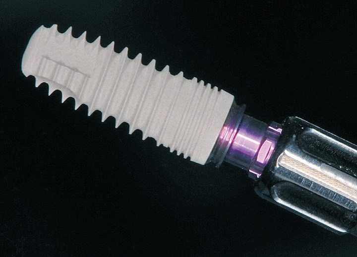 Abb. 4: Das SICvantage max für die Implantation in die Extraktionsalveole 14.