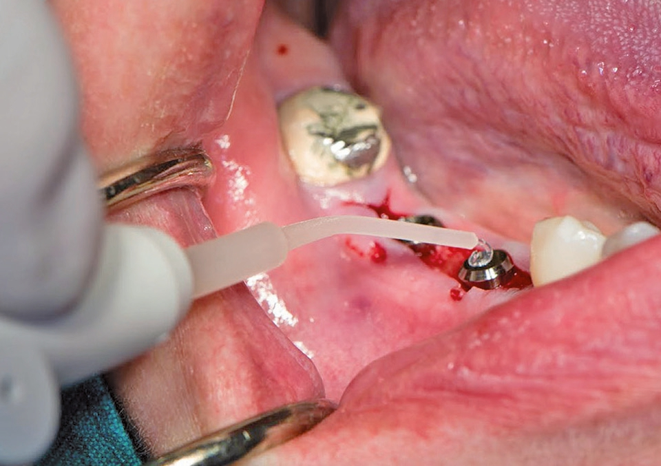 Abb. 4: Anwendung des Materials im osseointegrierten Implantat.