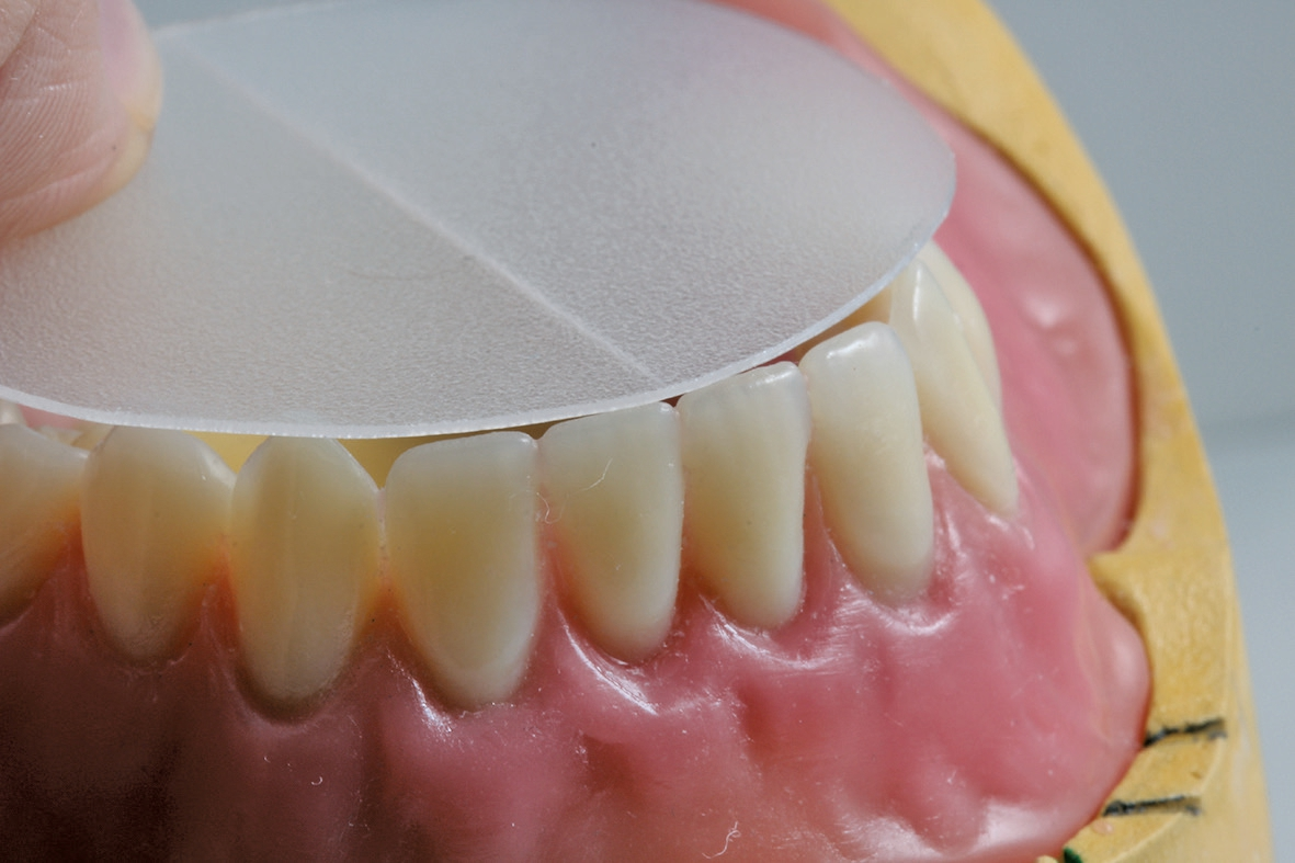 Abb. 4: Unterkieferfront mit Tiefziehfolie.