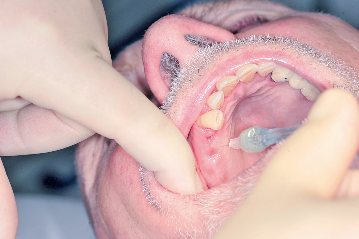 Abb. 4: Die Kanülenspitze wird in Höhe des Kieferkamms in die Gingiva eingeführt, bis ein Kontakt mit dem Knochengewebe spürbar wird. Im Einstichgebiet – fast auf Kieferkammmitte – wird ein großes Areal anämisch.