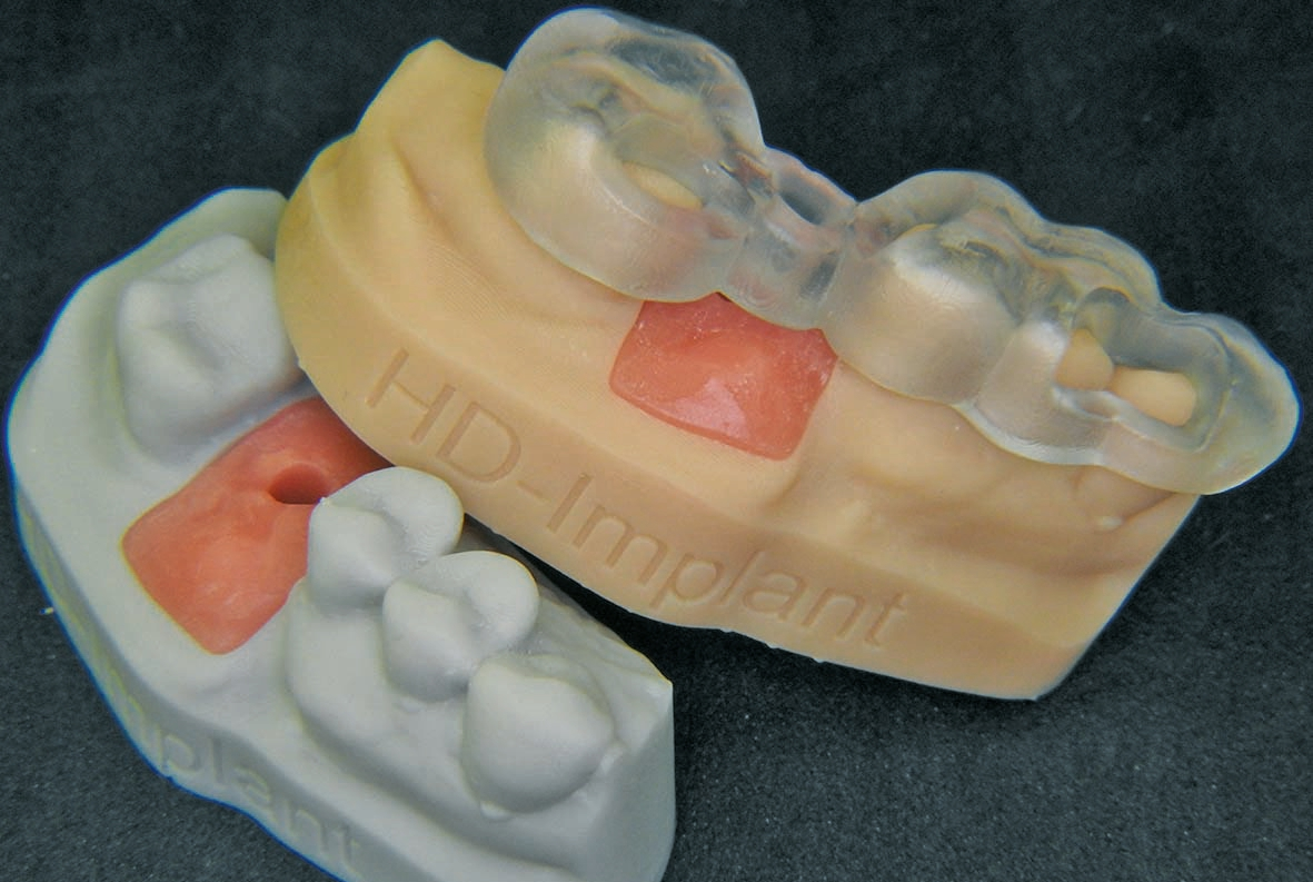 Abb. 4: Fertiges Implantatmodell mit abnehmbarer Zahnfleischmaske.