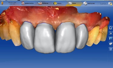 Abb. 5: Der Designvorgang der Kronen mit der CEREC-Software 4.6.1.