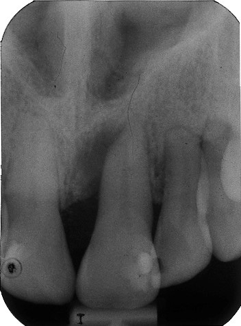 Abb. 4: Tiefer parodontaler Defekt am Zahn 11, der nach mesial einen Attachmentverlust von ca. 95% aufweist.