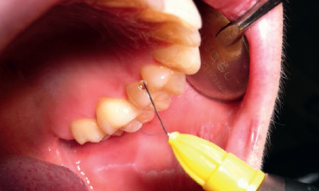Abb. 3: Ein Tropfen des Anästhetikums reduziert die Sensibilität der Gingiva.