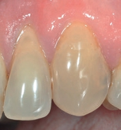 Abb. 4: Zahn 23 (Restauration mit G-BOND) und Zahn 24 (Restauration mit Optibond FL) nach 9 Jahren.