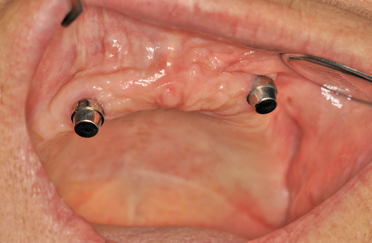 Abb. 4: Sekundärmagnete in situ auf den beiden Implantaten.