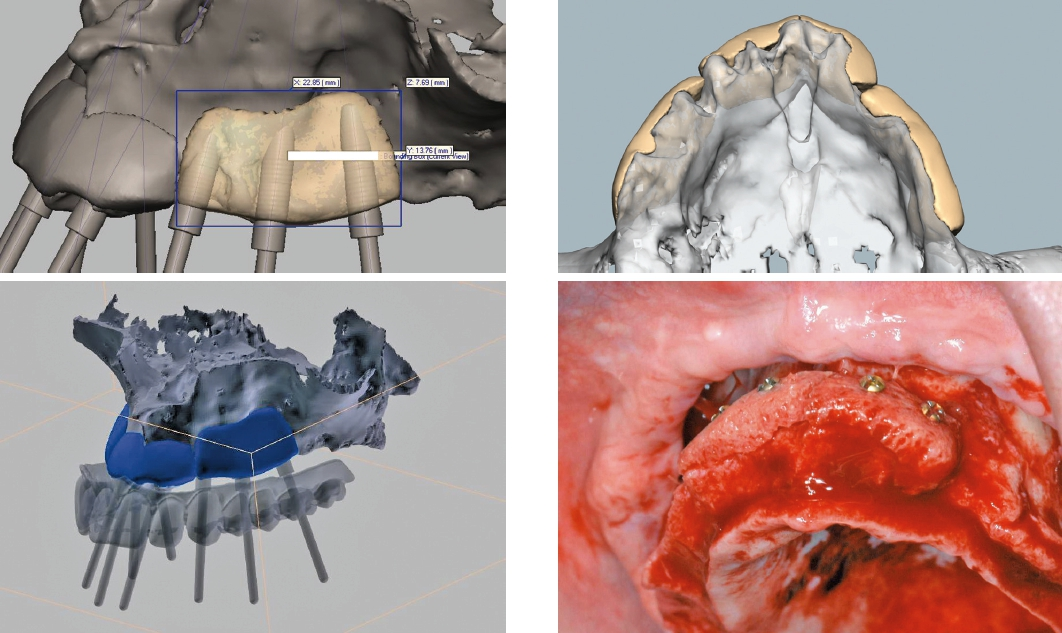 Abb. 2 bis 5: Auf Basis der CT/DVT-Daten von Kieferdefekten kann ein passendes allogenes Knochenimplantat mit Hilfe einer 3D-Planungssoftware zunächst virtuell konstruiert werden, um schließlich mittels eines speziellen Fräsprozesses das zuvor geplante patientenindividuelle Implantat anzufertigen.