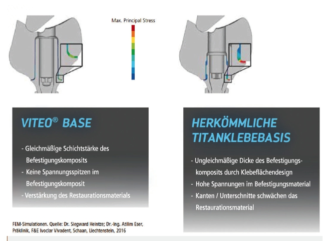 Abb. 4: Vergleich der Klebeflächengeometrie von Titanklebebasen bei einer Krafteinleitung von 300 N.