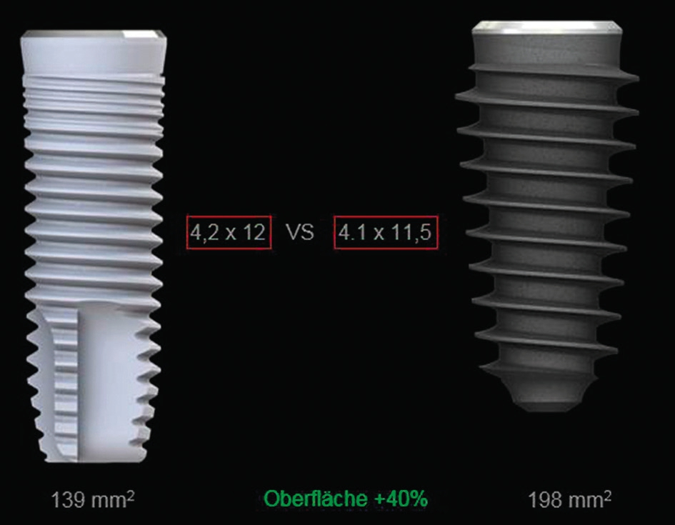 Abb. 4: Gewöhnliches Implantat (links) im Vergleich zu AnyRidge (rechts): deutlicher Unterschied in der Oberflächengröße durch das Gewindedesign.