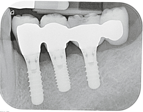 Zustand nach Periimplantitistherapie – derartige (erfreuliche) Ergebnisse sind allerdings auch bei Befolgen der in den aktuellen Leitlinien vorgeschlagenen Behandlungsstrategien nicht vorhersagbar.