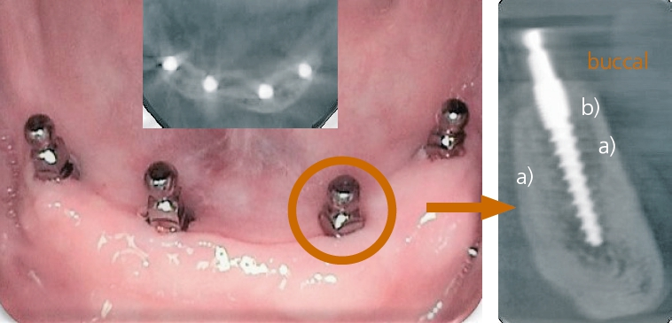 Abb. 7-9: Alle Champions-Minis wurden „mittig“ im Knochen transgingival inseriert (Kontrolle DVT). Durch die richtige Bohr-Kondensationstechnik ist auch immer die „Befestigte Gingiva“ bukkal der Implantate verifizierbar, was auch ein wesentliches Erfolgskriterium ist. Dies ist jedoch lingual des Implantats primär nicht wichtig, da sich diese nach einigen Wochen sogar bildet und keine „Schmutznische“ darstellt. Bukkal jedoch sollte unbedingt eine befestigte Gingiva vorhanden sein!