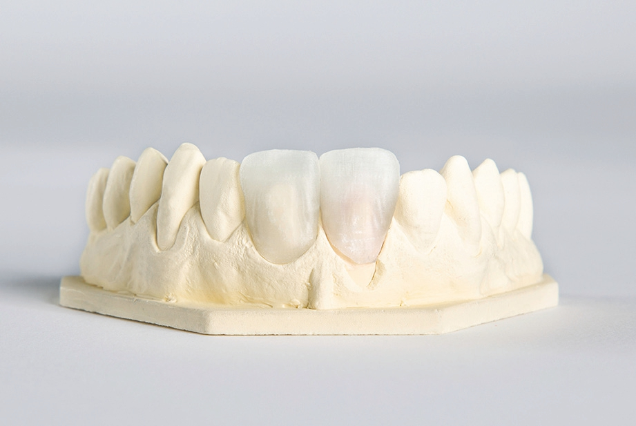 Abb. 4: Modell für die Kronen- und Brücken-Technik mit Zähnen aus CastFill-Filament, gedruckt mit dem Ultimaker 3.